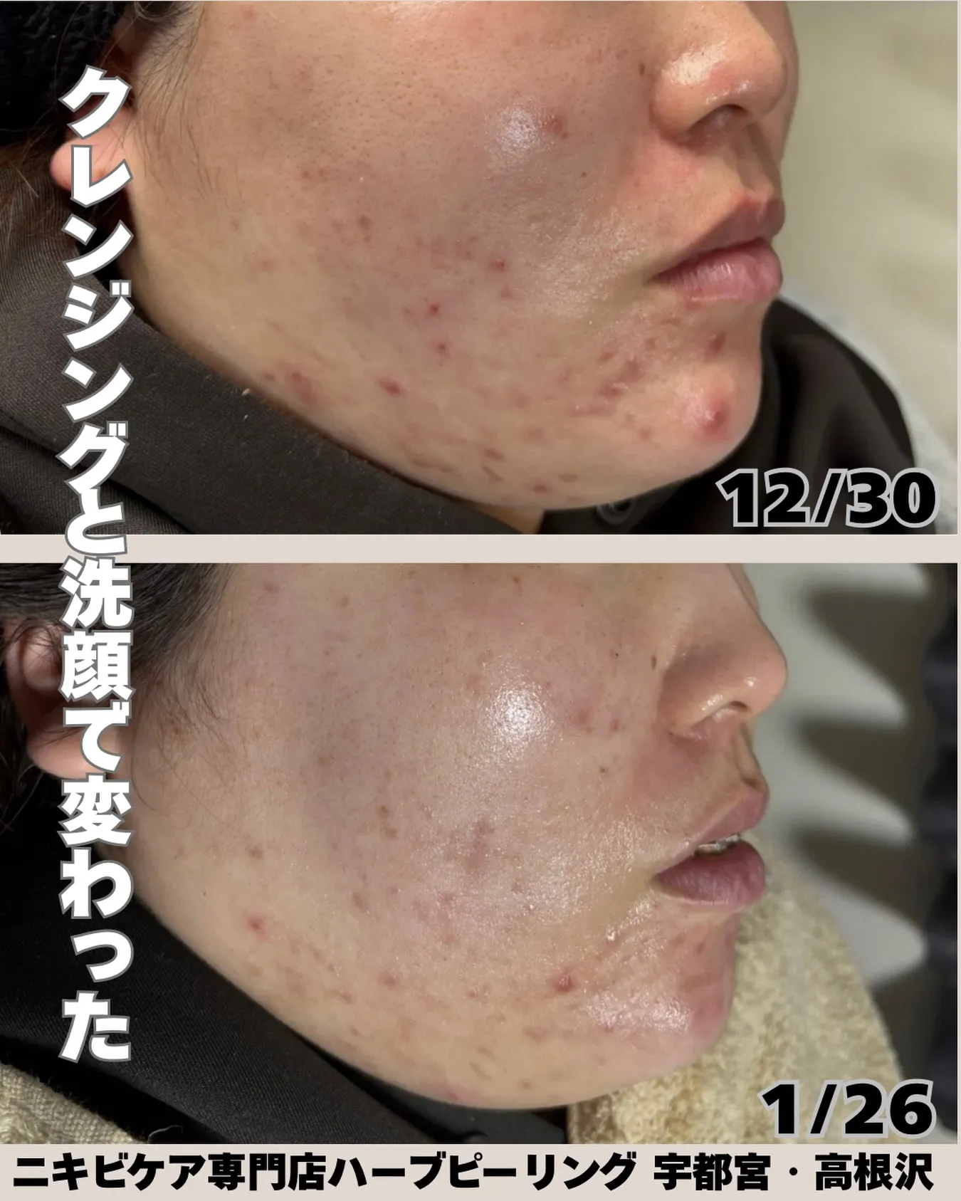 実はこの1ヶ月、ハーブピーリングはしていません。