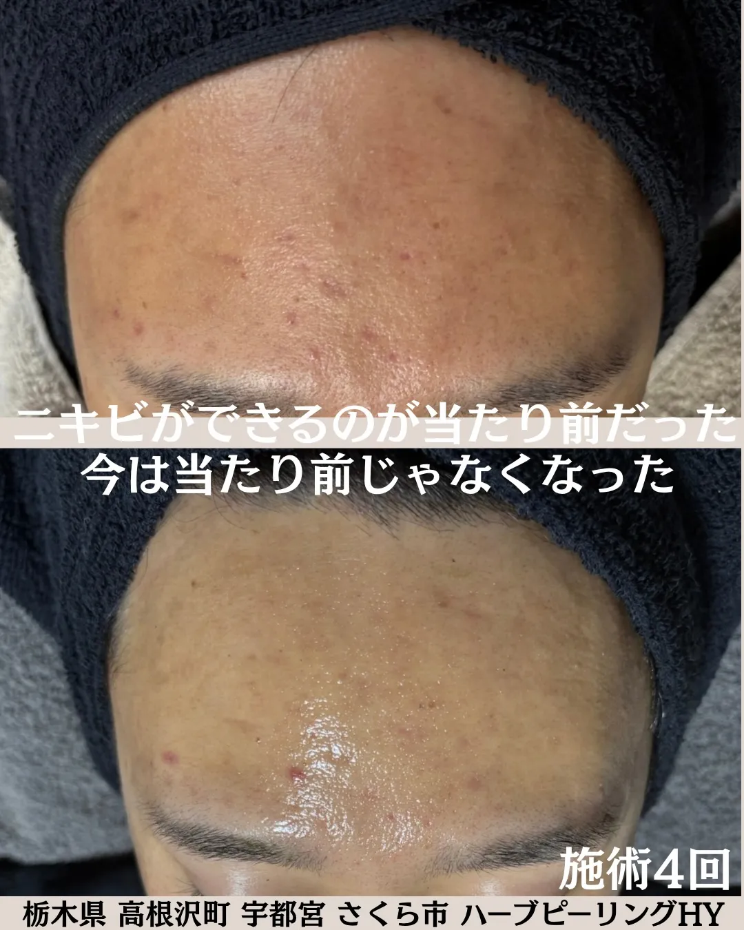写真は施術前と施術4回後の比較です。