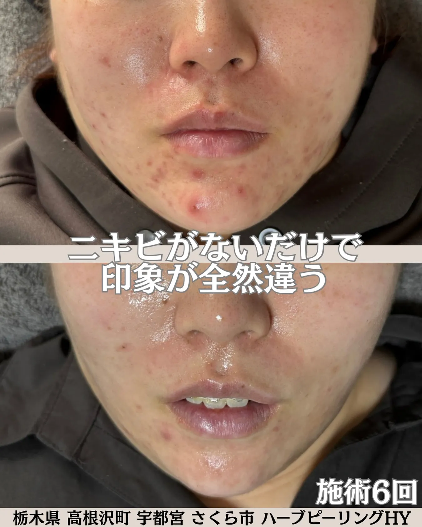 ハーブピーリング6回での素晴らしい変化です!